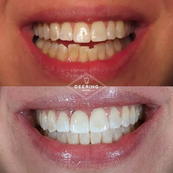 Cosmetic treatment in Miami at Deering Dental